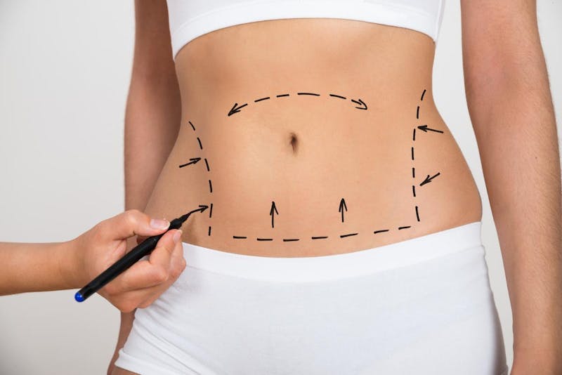 Incision Marks on a Tummy