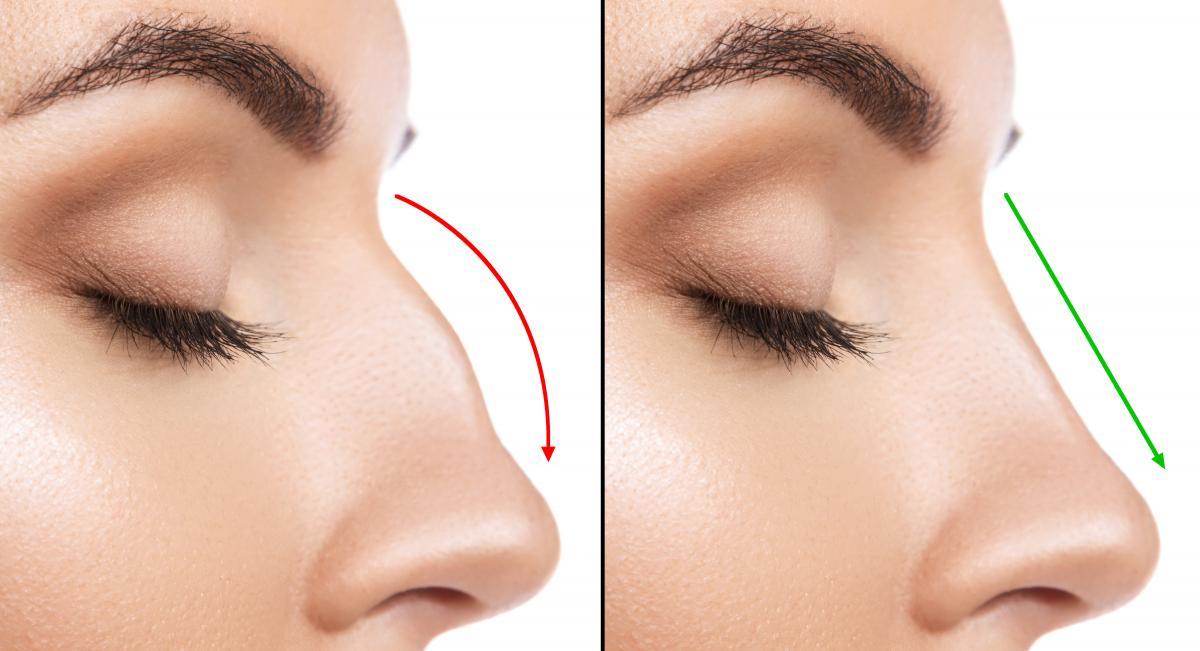 Facial Profile Rhinoplasty