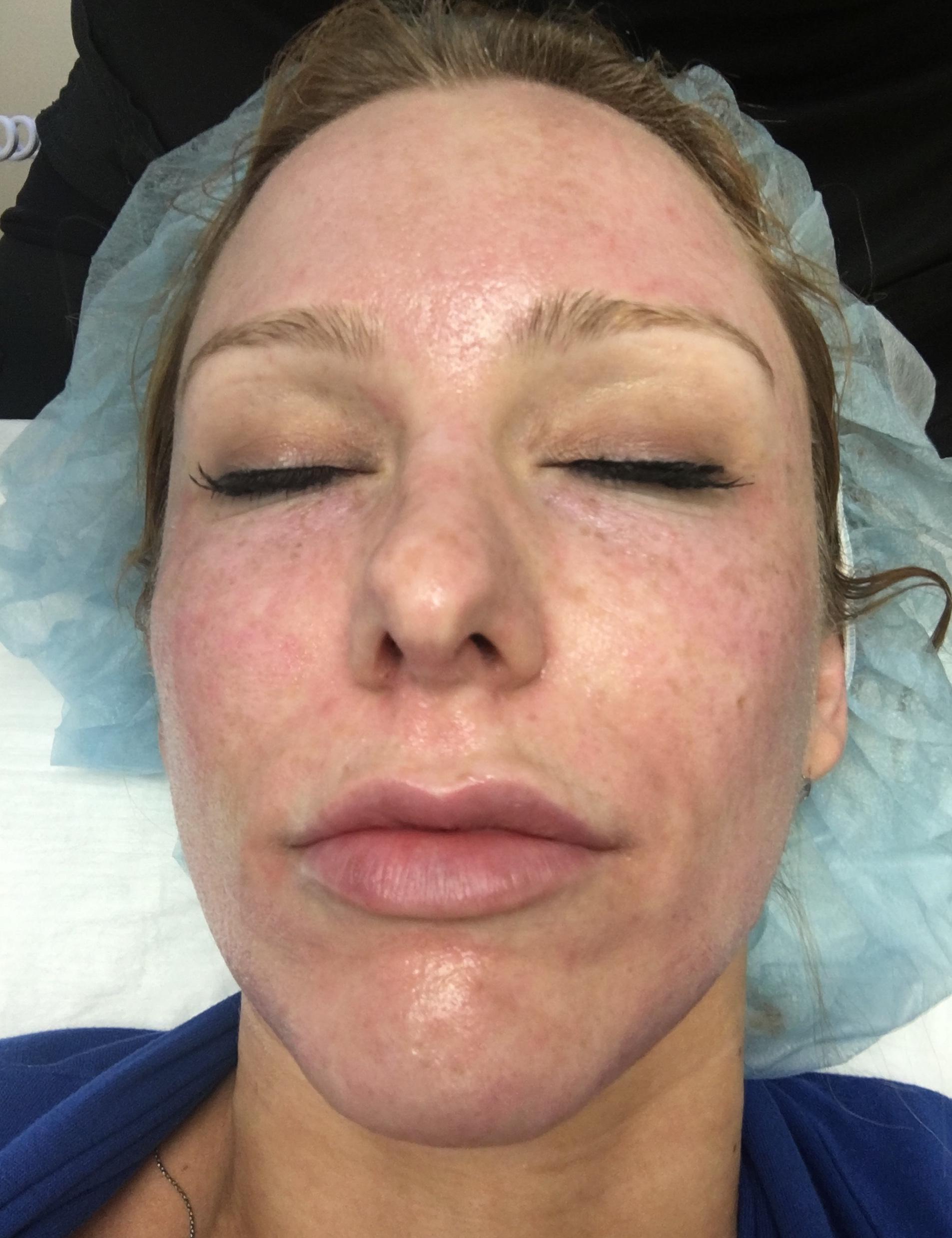 Before And After CO2 Laser Skin Resurfacing