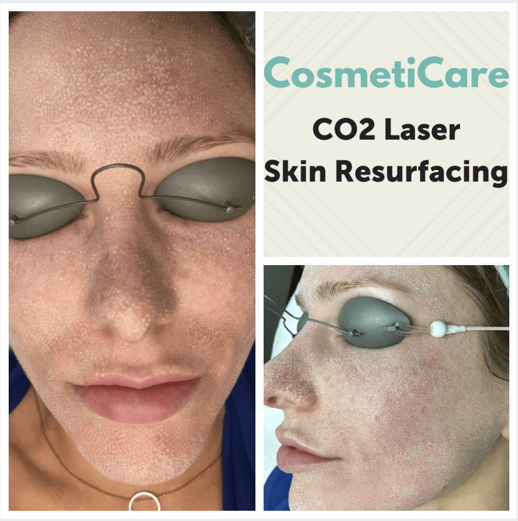 Before And After CO2 Laser Skin Resurfacing