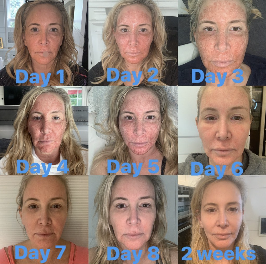 Two Weeks of CO2 Lasker Skin Resurfacing