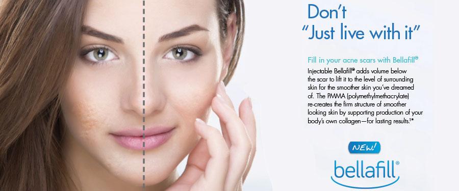 Bellafill Acne Scar Treatment