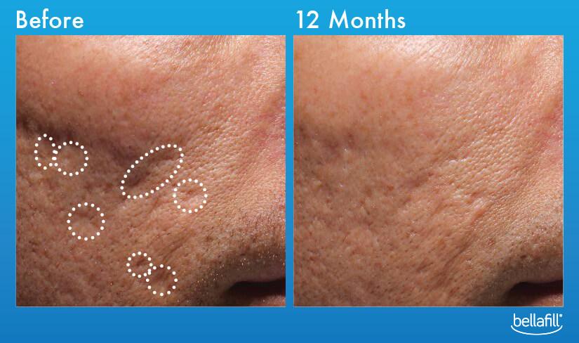 Bellafill Acne Scar Treatment 