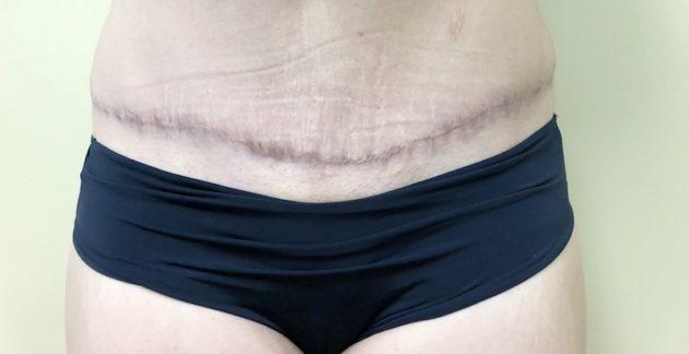 Tummy Tuck Scar Before ClearLift