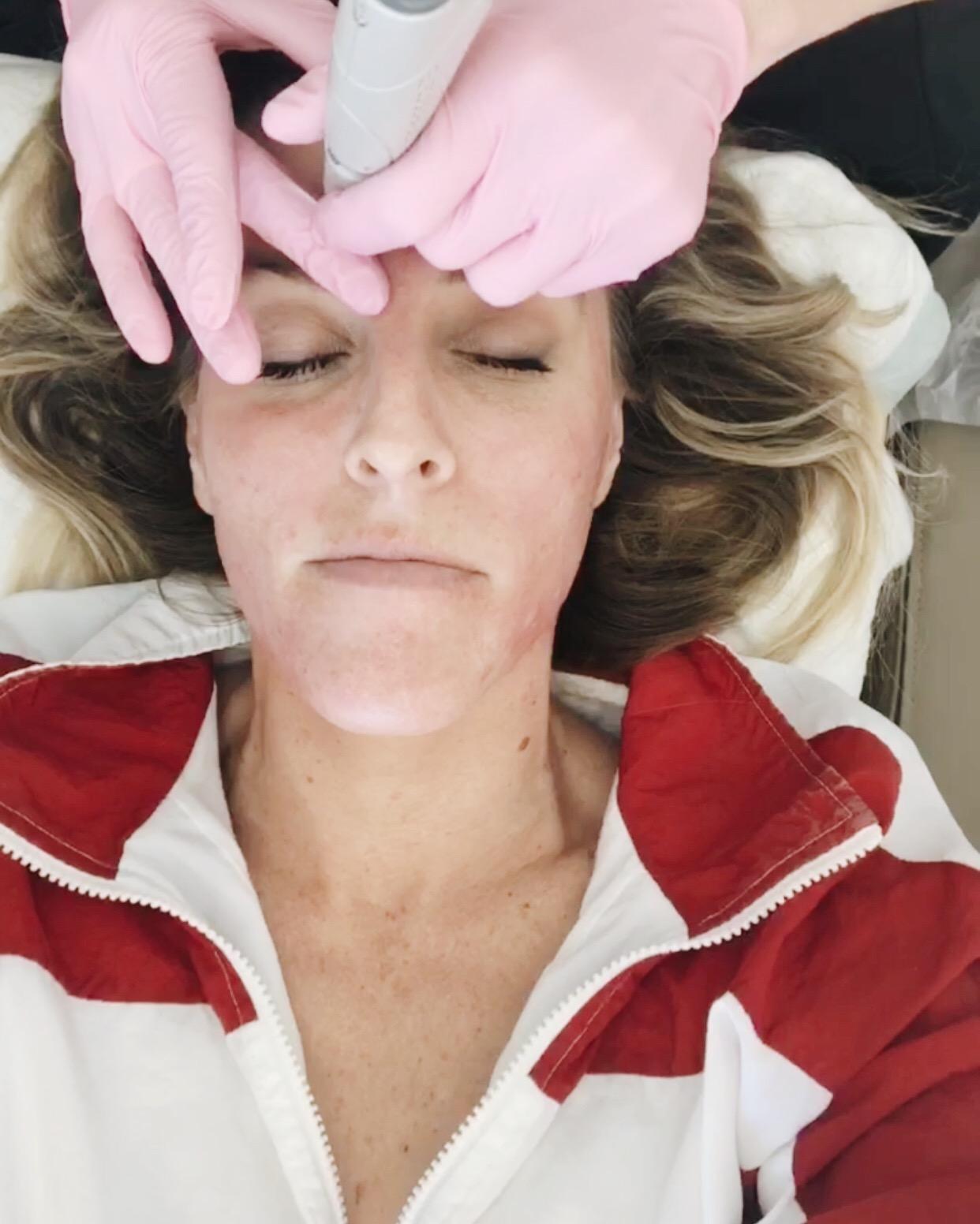 Beth Jones Hydrafacial