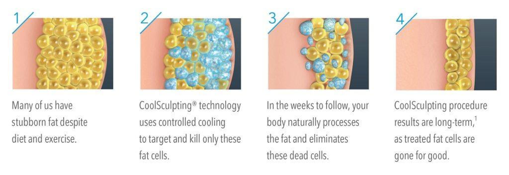 Coolsculpting Process