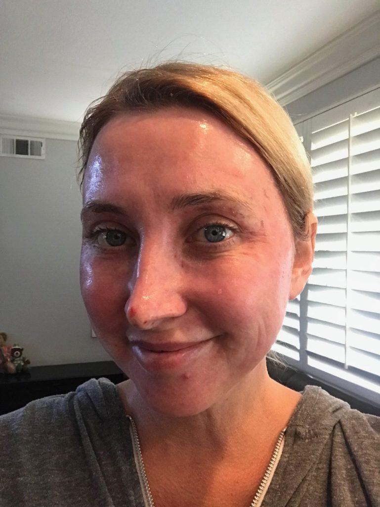 Fresh skin after a C02 Laser at CosmetiCare