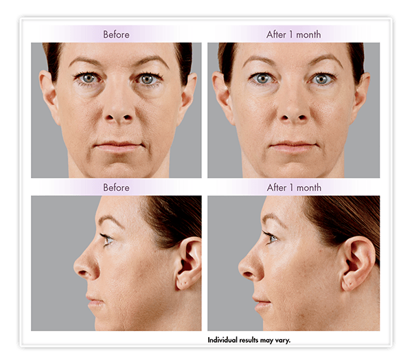 Juvéderm Voluma XC Before and After Example v1