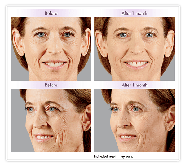 Juvéderm Voluma XC Before and After Example v2