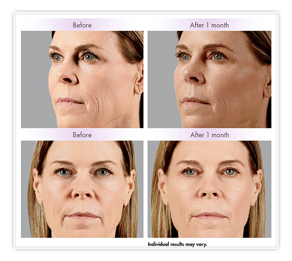 Juvéderm Voluma XC Before and After Example v3