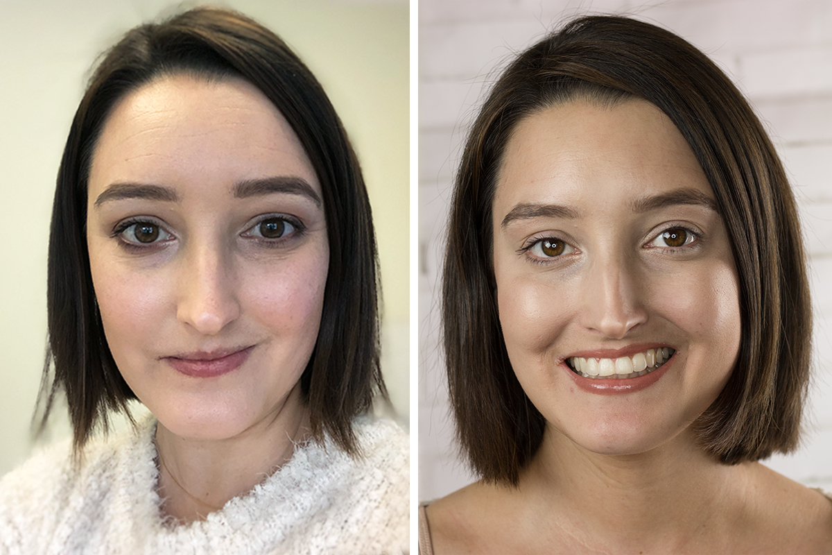 Before/After Botox Injections from CosmetiCare | A Good Hue