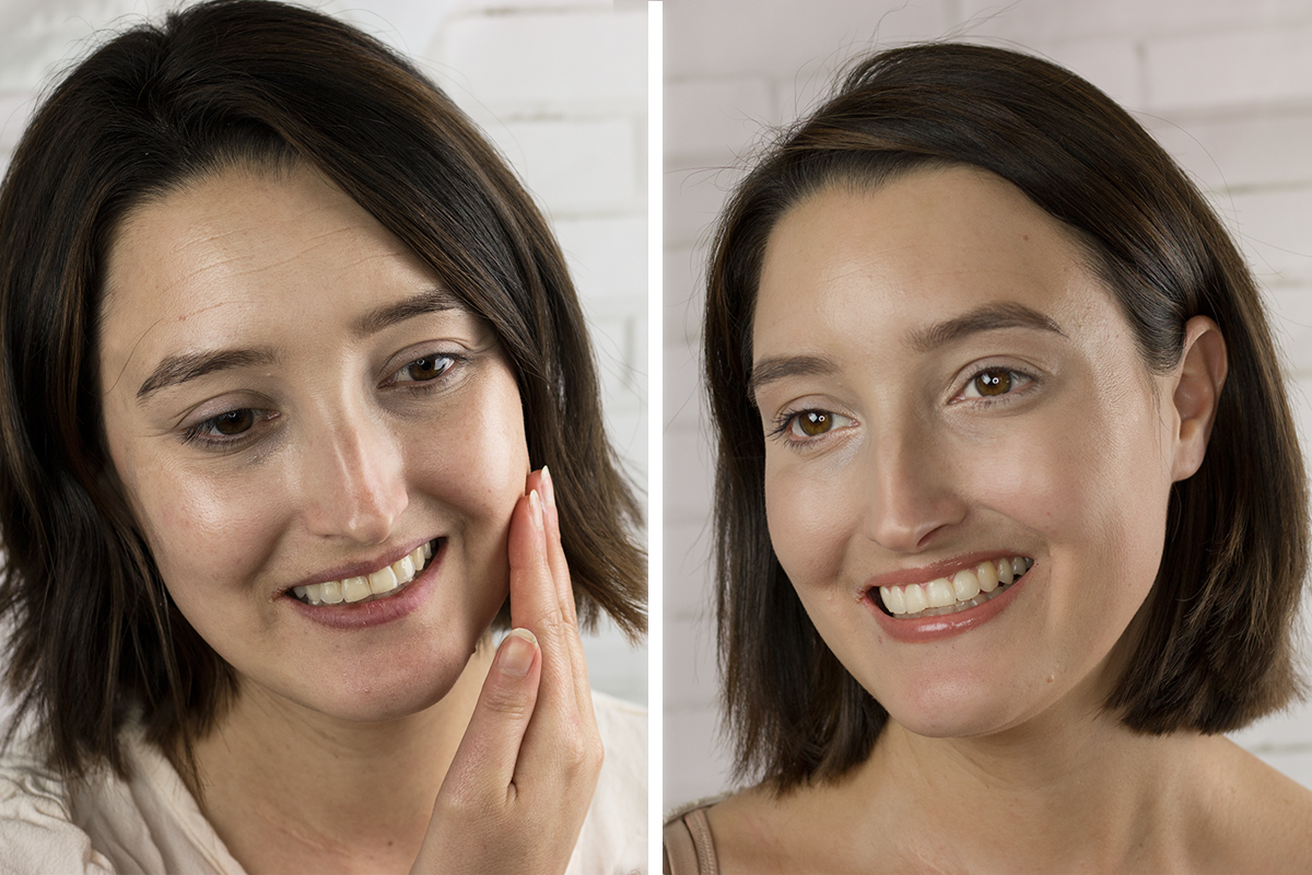 Before/After Botox Injections from CosmetiCare | A Good Hue