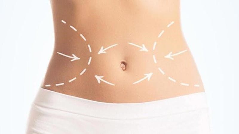 Benefits of Combining Liposuction with BodyTite - CosmetiCare