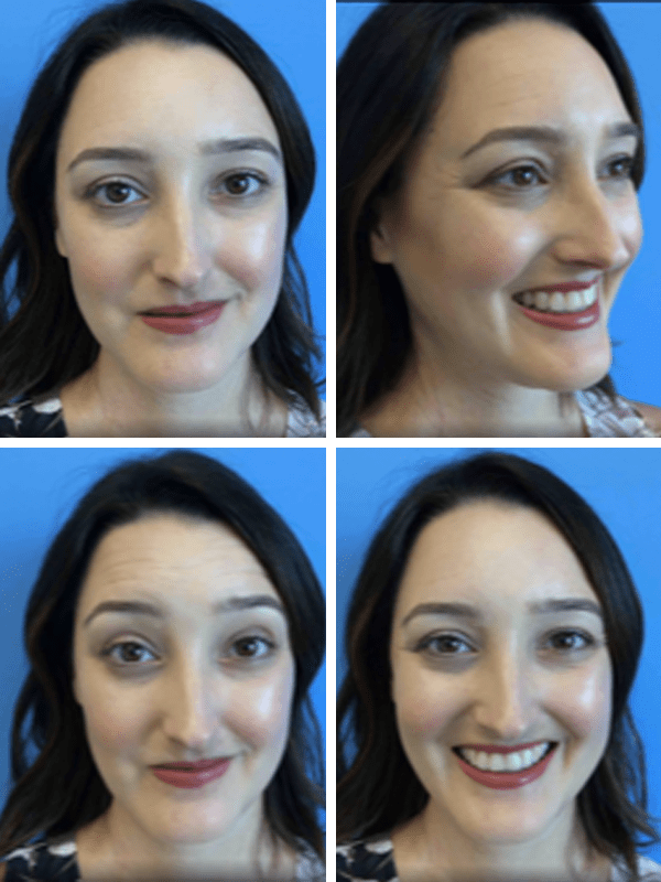 BEFORE: Botox injections at CosmetiCare, Newport Beach | A Good Hue
