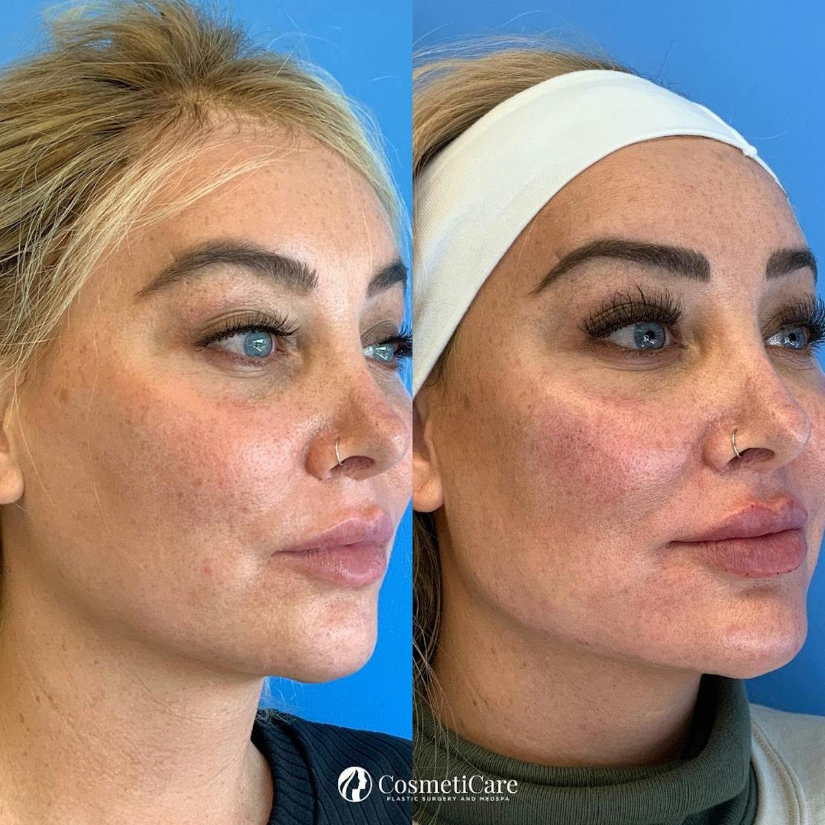 Dermal Fillers Before & After Gallery - Patient 75082378 - Image 1