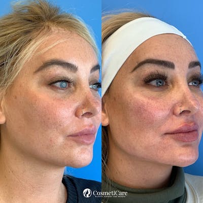 Dermal Fillers Before & After Gallery - Patient 75082378 - Image 1