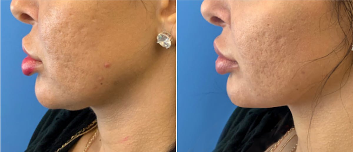 Laser Skin Tightening Before & After Gallery - Patient 132872057 - Image 1