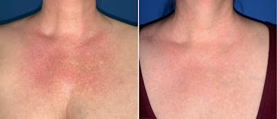 Laser Skin Tightening Before & After Gallery - Patient 132872058 - Image 1