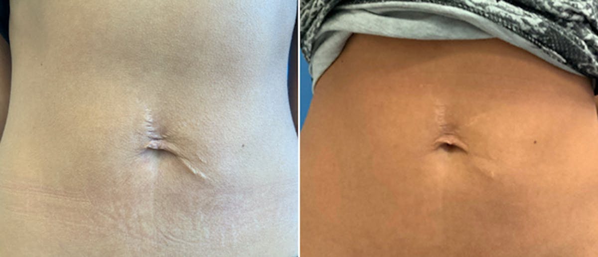 Laser Skin Tightening Before & After Gallery - Patient 132872059 - Image 1