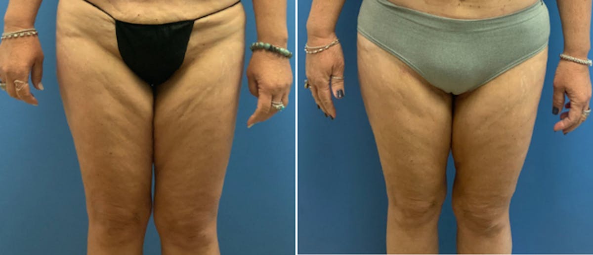 Thigh Lift Before & After Gallery - Patient 133090022 - Image 1