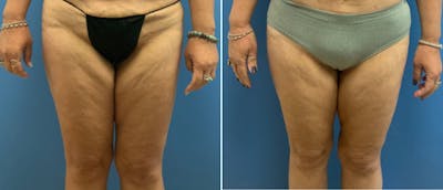 Thigh Lift Before & After Gallery - Patient 133090022 - Image 1