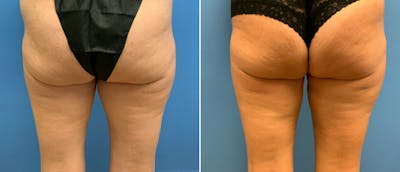 Thigh Lift Before & After Gallery - Patient 133090023 - Image 1