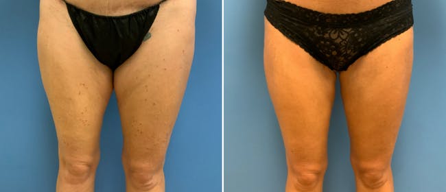 Thigh Lift Before & After Gallery - Patient 133090023 - Image 2
