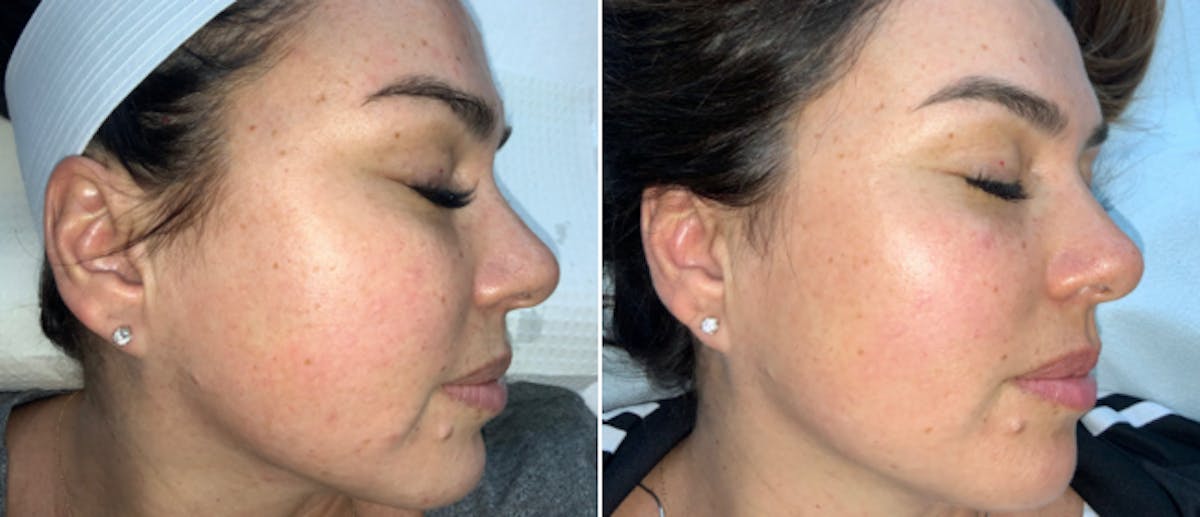 Cosmelan Peel Before & After Gallery - Patient 162043811 - Image 1