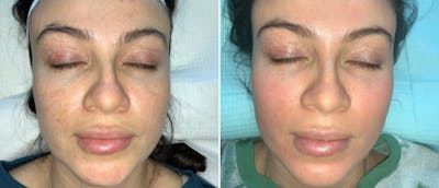 Cosmelan Peel Before & After Gallery - Patient 162043812 - Image 1