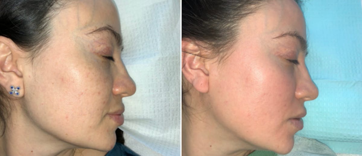 Cosmelan Peel Before & After Gallery - Patient 162043812 - Image 2