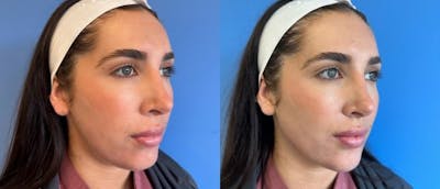 Jawline Contouring Before & After Gallery - Patient 166984166 - Image 1