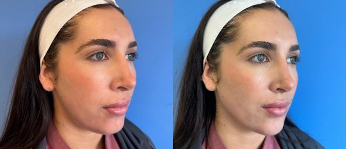Jawline Contouring Before & After Gallery - Patient 166984166 - Image 1
