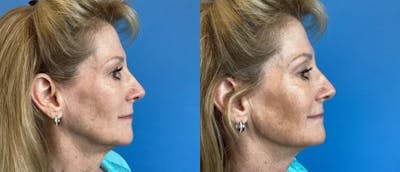 Jawline Contouring Before & After Gallery - Patient 166984167 - Image 1