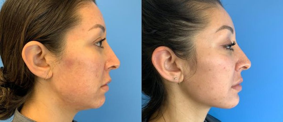 Jawline Contouring Before & After Gallery - Patient 166984168 - Image 1