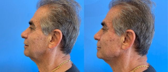 Jawline Contouring Before & After Gallery - Patient 166984169 - Image 1