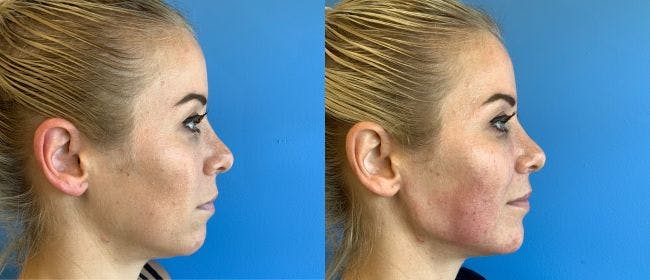 Jawline Contouring Before & After Gallery - Patient 166984170 - Image 1