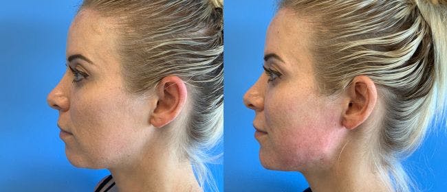 Jawline Contouring Before & After Gallery - Patient 166984170 - Image 2