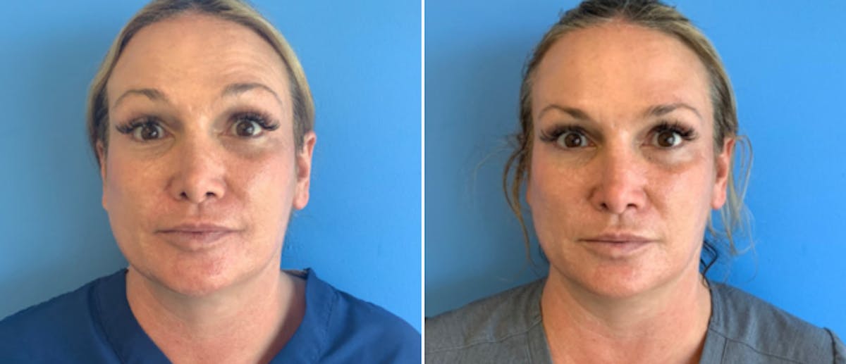 Botox Before & After Gallery - Patient 175045847 - Image 1