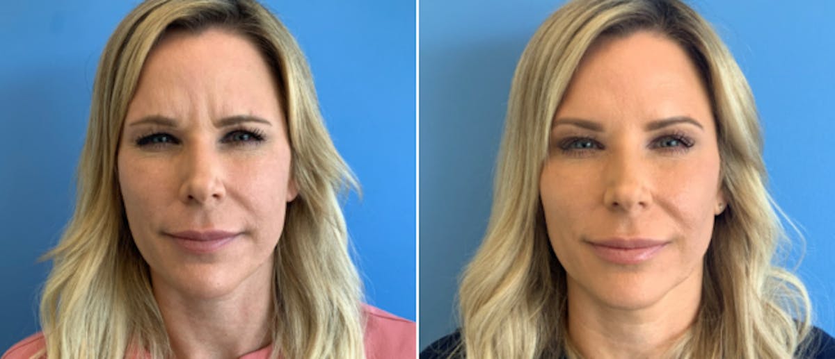 Botox Before & After Gallery - Patient 175045848 - Image 2