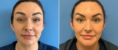 Botox Before & After Gallery - Patient 175045849 - Image 1