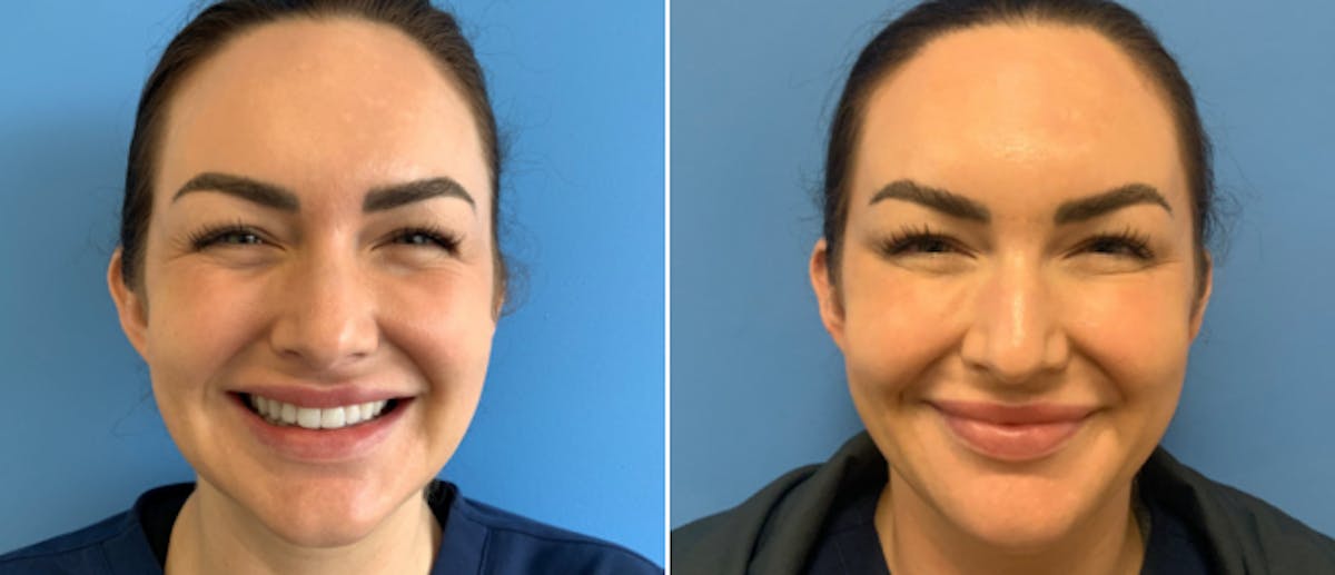 Botox Before & After Gallery - Patient 175045849 - Image 2