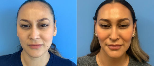 Botox Before & After Gallery - Patient 175045850 - Image 1