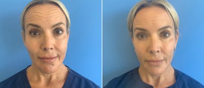 Botox Before & After Gallery - Patient 175045851 - Image 1