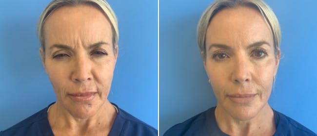 Botox Before & After Gallery - Patient 175045851 - Image 2