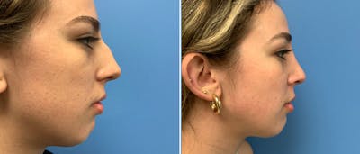 Rhinoplasty Before & After Gallery - Patient 180497959 - Image 1