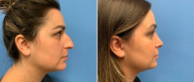 Rhinoplasty Before & After Gallery - Patient 180497960 - Image 1