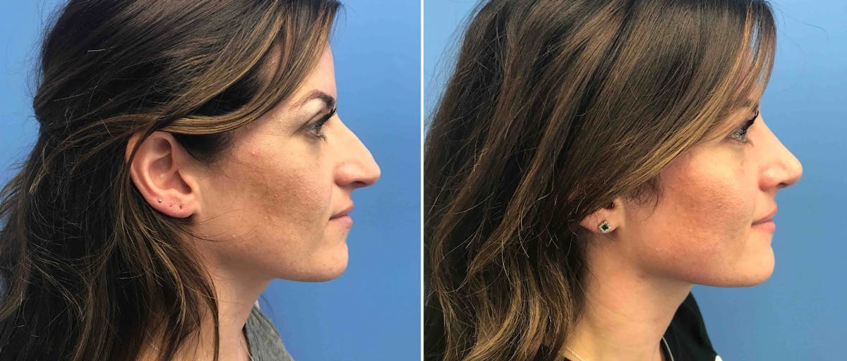Rhinoplasty Before & After Gallery - Patient 181057851 - Image 1