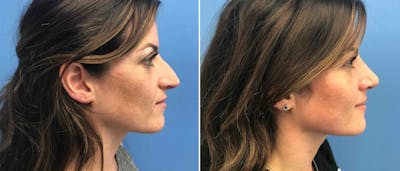 Rhinoplasty Before & After Gallery - Patient 181057851 - Image 1