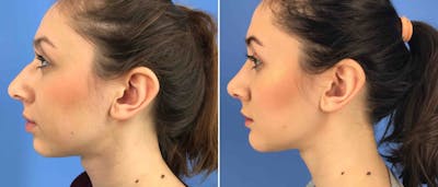 Rhinoplasty Before & After Gallery - Patient 181057867 - Image 1