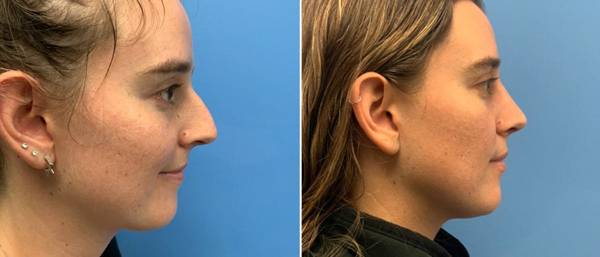 Rhinoplasty Before & After Gallery - Patient 181057868 - Image 1